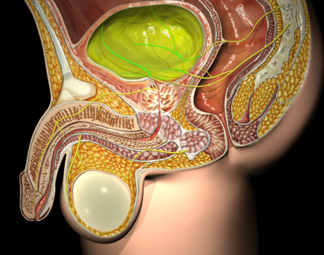 Benign prostatic hyperplasia (BPH)